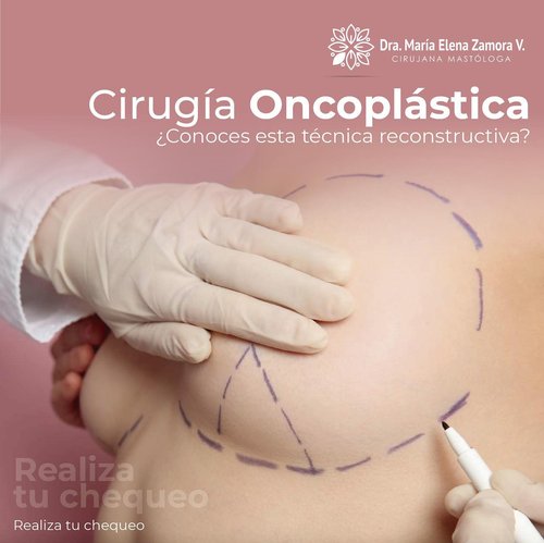Caso clínico: marcación pre-quirúrgica para cirugía oncoplástica conservadora