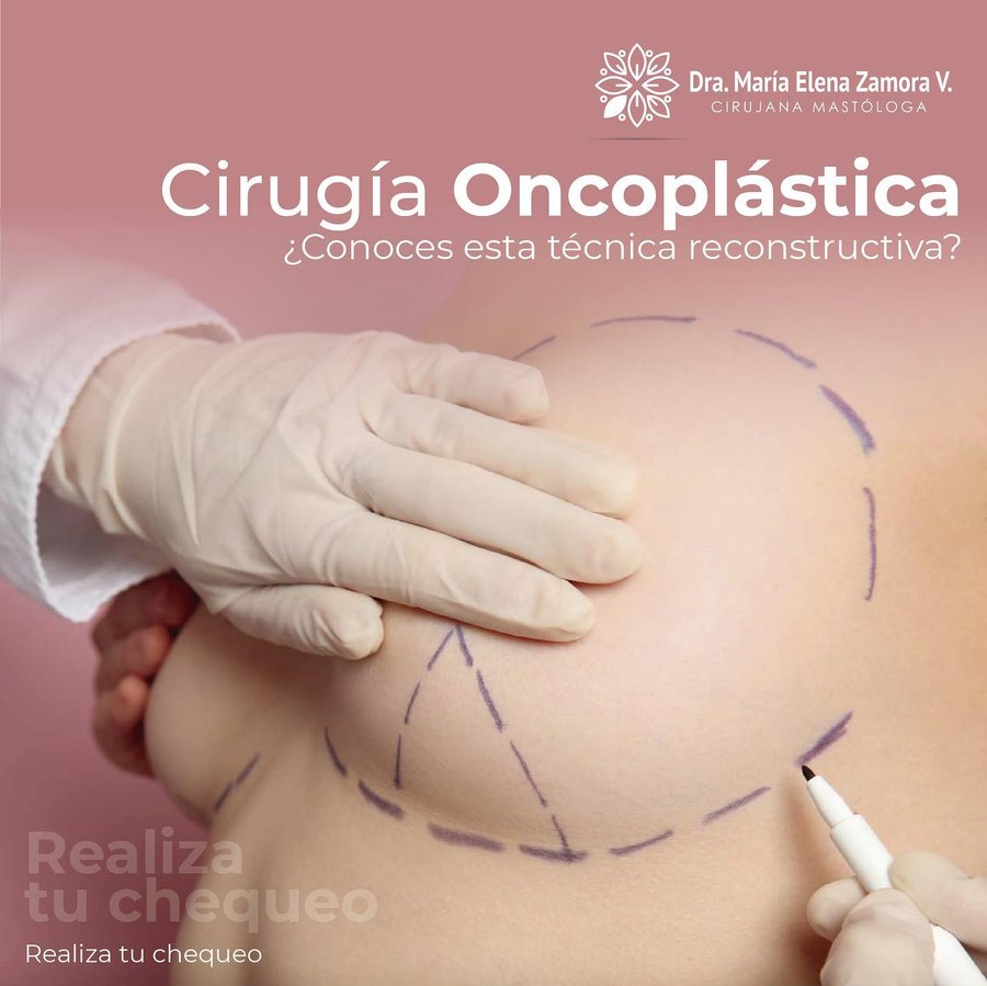 Caso clínico: marcación pre-quirúrgica para cirugía oncoplástica conservadora