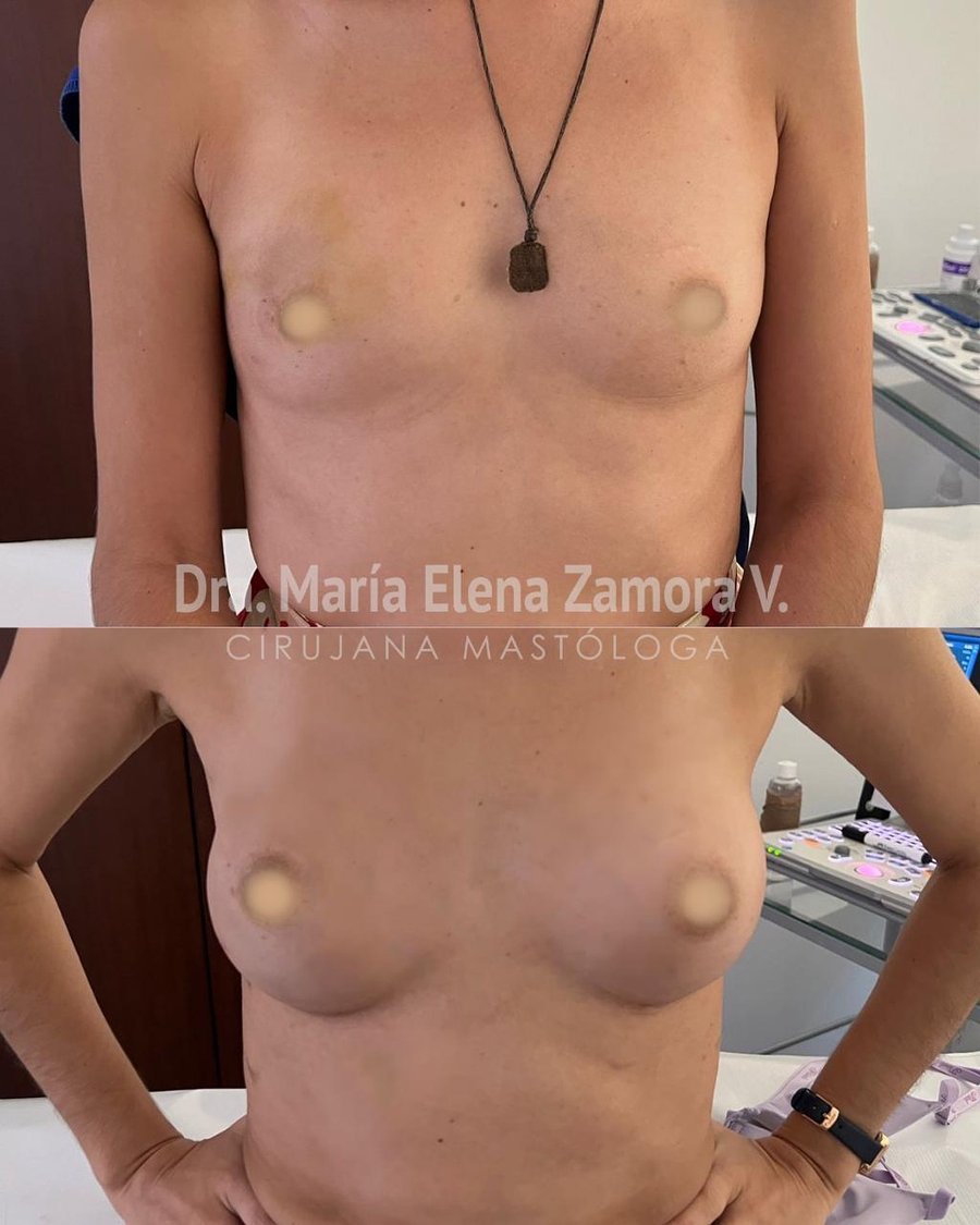 Caso clínico: antes y después de mastectomía con conservación de piel, areola y pezón, y reconstrucción inmediata