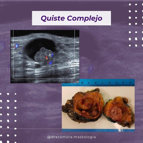 Caso clínico: quiste complejo, ecografía y pieza quirúrgica